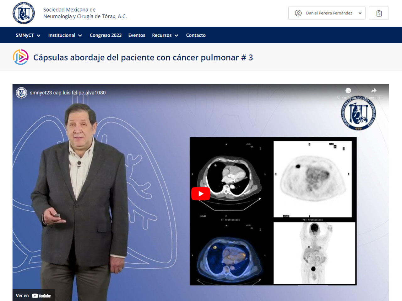 Cápsulas # 3. "Nódulo pulmonar solitario"